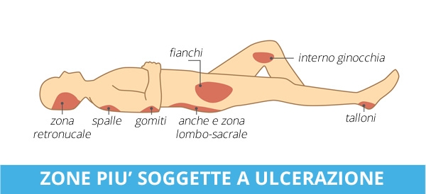 Le piaghe da decubito nelle persone anziane